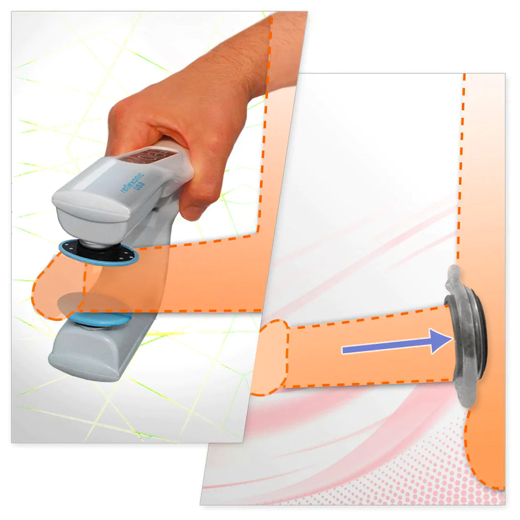 Maintaining Erection with Viberect and Constriction Ring